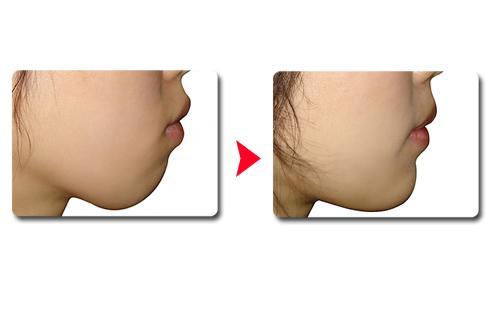 2023年上海市哪家醫(yī)院是最受網(wǎng)友認(rèn)可的做隆胸整形醫(yī)院？排名前六強(qiáng)！