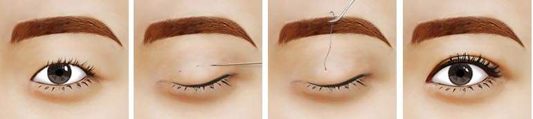 2023年天津公立醫(yī)院雙眼皮手術(shù)排名及網(wǎng)友好評！