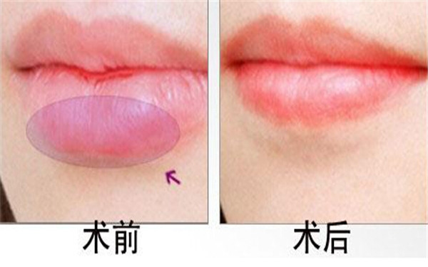 廈門線雕改善臉部下垂醫(yī)生