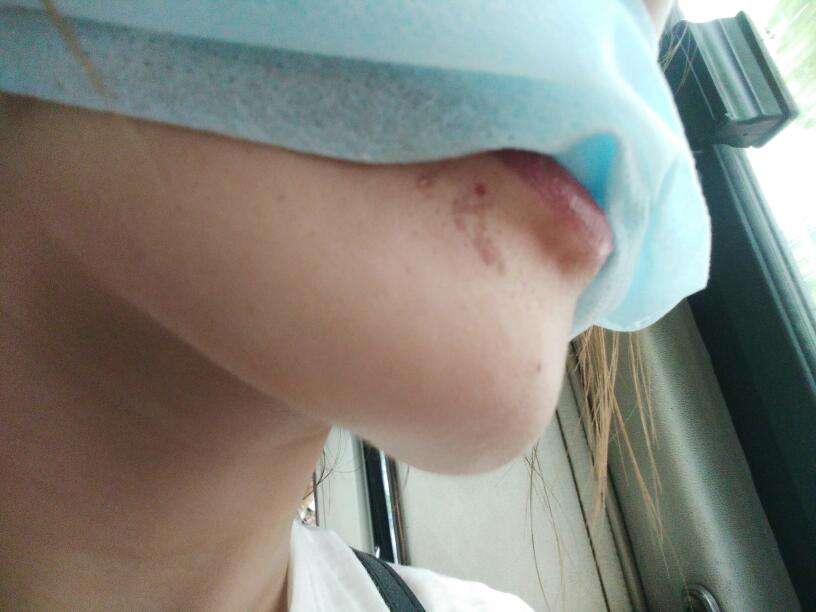 濟南激光溶脂瘦后背醫(yī)生