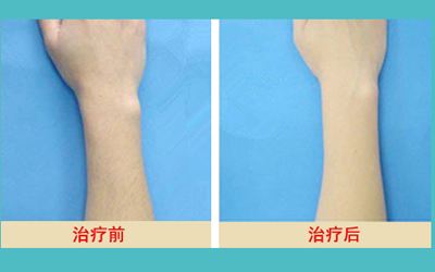 2023徐州洗紋身醫(yī)院匯總：盤點(diǎn)最受歡迎的五家，誰是洗紋身的明星？