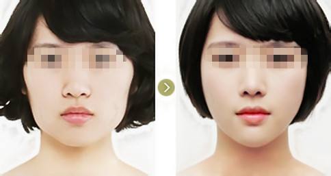 廈門鼻孔開大術醫(yī)生