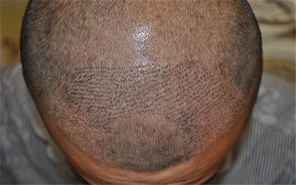 2023鄭州洗紋身醫(yī)院排行出爐！驚喜！