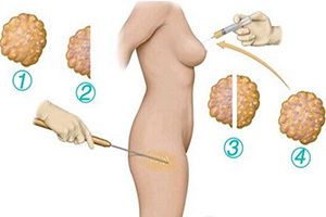 上海九院：網(wǎng)友推薦的面部吸脂醫(yī)生前五名曝光！