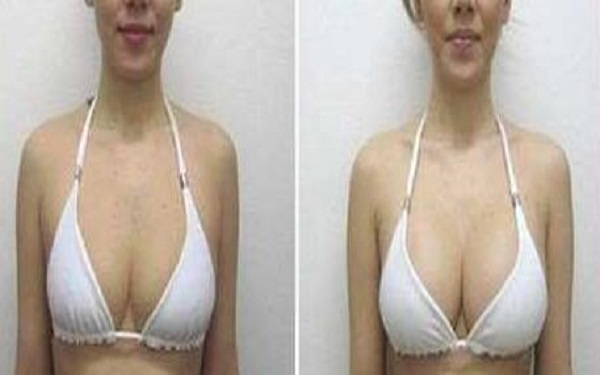 東莞最佳度膨體隆鼻醫(yī)院匯總：華美、維多利亞、禾美、知美脫穎而出！讓你一探究竟！