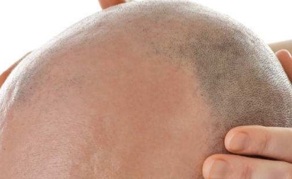 華美醫(yī)院榮登山東菏澤祛疤第一名，絕佳口碑再次奪冠！