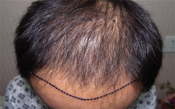 內(nèi)蒙古烏蘭浩特市最佳修復(fù)雙眼皮技術(shù)，誠(chéng)意推薦的專(zhuān)業(yè)醫(yī)療機(jī)構(gòu)排行榜