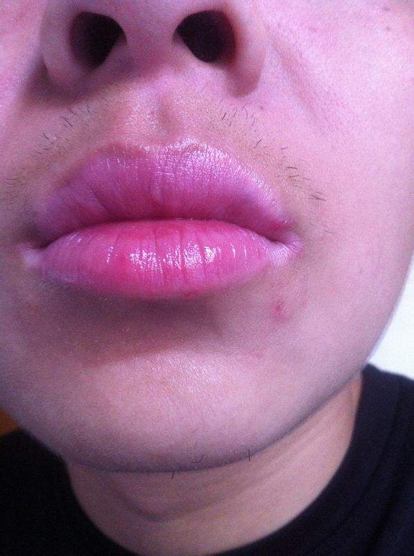 南寧玻尿酸面頰除皺醫(yī)生