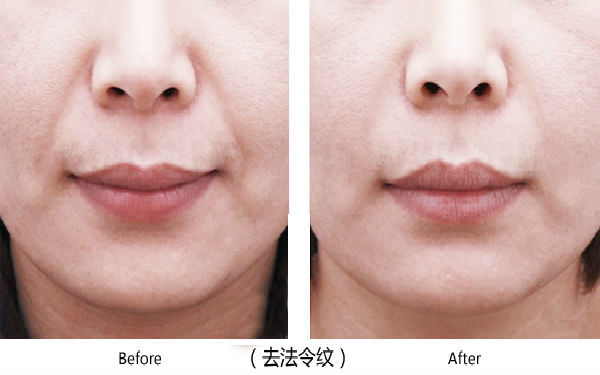 寶雞整容醫(yī)院大整頂級(jí)優(yōu)質(zhì)匯總！高一生對(duì)決愛容妍_絕對(duì)實(shí)力的對(duì)比震撼