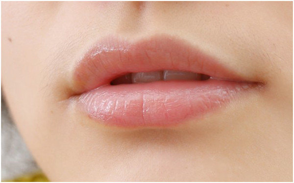 永州物理去除川字紋醫(yī)生