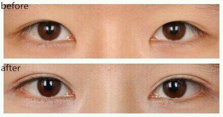 蘭州假體隆胸手術(shù)醫(yī)生