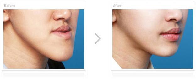 嘉興市最佳雙眼皮醫(yī)院評(píng)選揭曉！網(wǎng)友留言熱議翻墻！