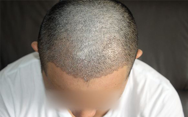 昆明脂肪填充整形醫(yī)院推薦！揭秘昆明四家專業(yè)醫(yī)美機(jī)構(gòu)，必看！