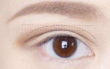 昆明眼睛細紋凹陷填充醫(yī)生