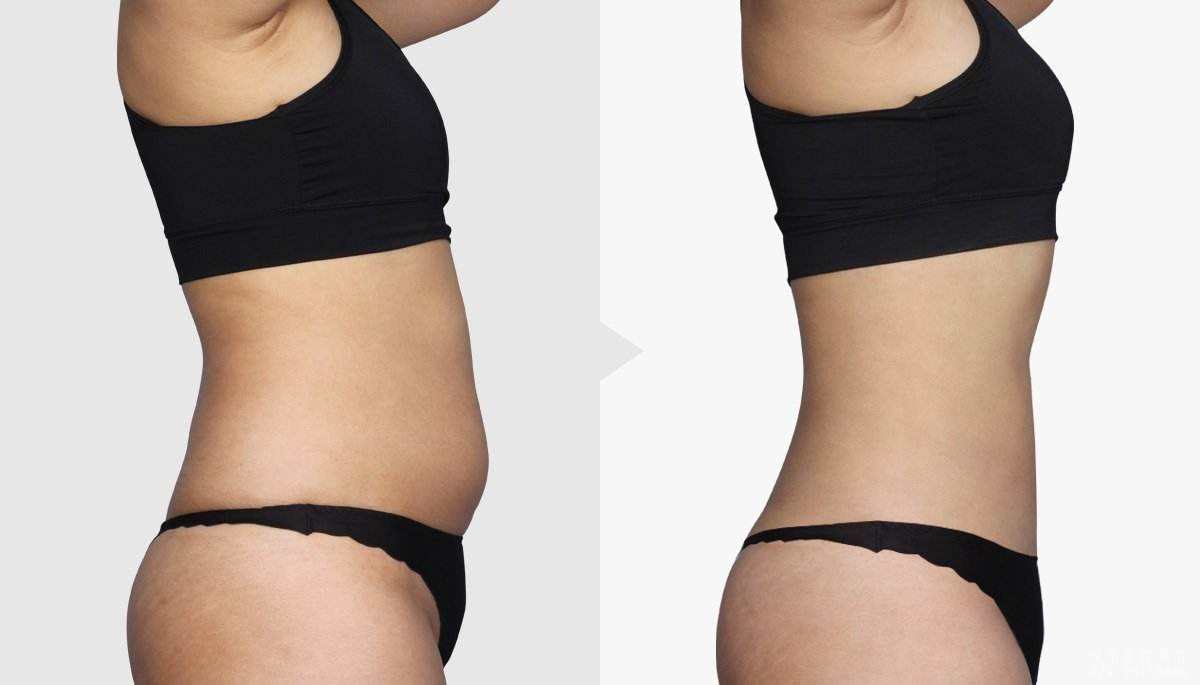 泉州硅膠豐胸手術醫(yī)生