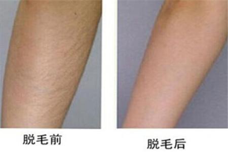 西安黃金微雕去眼周紋醫(yī)生