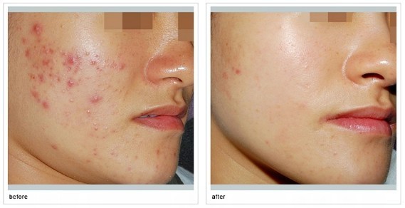 煙臺2023年最受青睞的割雙眼皮醫(yī)院：壹美天成、鵬愛、洛神、青韓、知顏排名TOP！