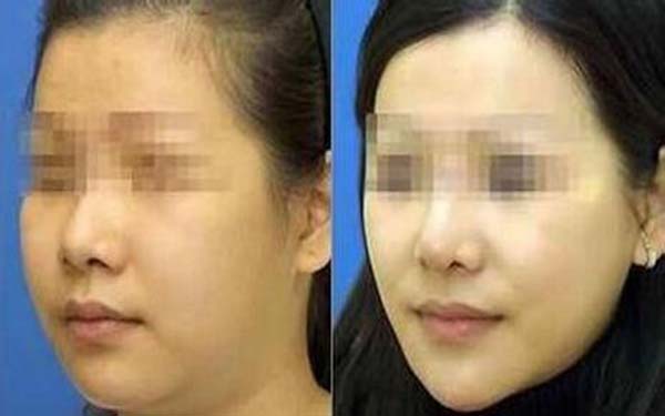 鄭州地區(qū)綜合排名靠前的雙眼皮醫(yī)院Top 5！當(dāng)?shù)丶夹g(shù)精湛且備受歡迎