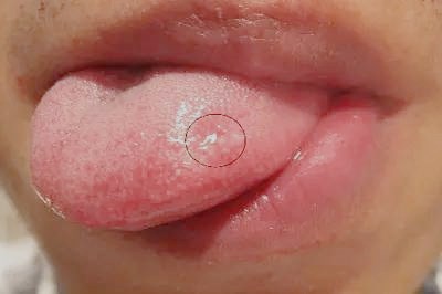 深圳細胞填充眼袋醫(yī)生