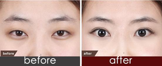 上海細紋填充膠原蛋白醫(yī)生