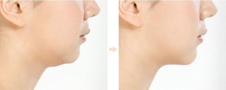 洛陽小切口祛除頸紋醫(yī)生