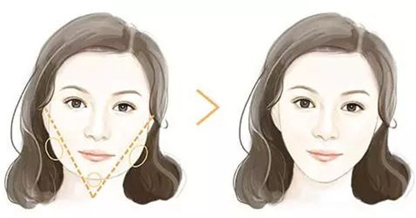 長(zhǎng)春法令紋去除手術(shù)醫(yī)生