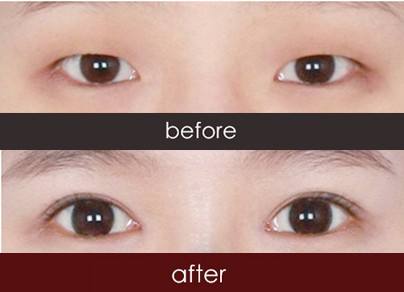 濟寧激光除眼底紋醫(yī)生