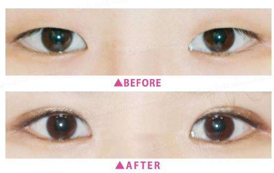 2023寧波眼瞼疤痕修復(fù)美容醫(yī)院排名揭曉！專業(yè)修復(fù)眼瞼疤痕的醫(yī)院在這！