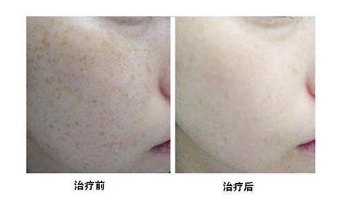 中山細(xì)紋剝離術(shù)醫(yī)生