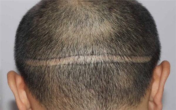 2023年天津黑眼圈治療醫(yī)院推薦，看看那位醫(yī)生的技術(shù)厲害