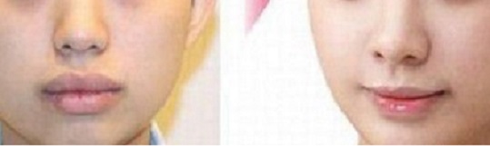 2023長沙微針去痘哪家醫(yī)院技術(shù)出眾？長沙微針去痘排名前十專業(yè)醫(yī)院揭秘！