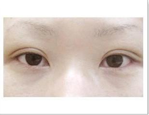 廣州有效祛斑的指導(dǎo)：2023年比較推崇的激光去斑醫(yī)院前十強(qiáng)