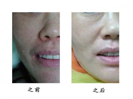 南通激光去除靜態(tài)紋醫(yī)生