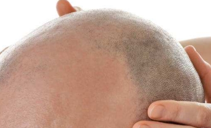 2023年十大口碑好的深圳水光針去眼底紋整形醫(yī)院揭秘！