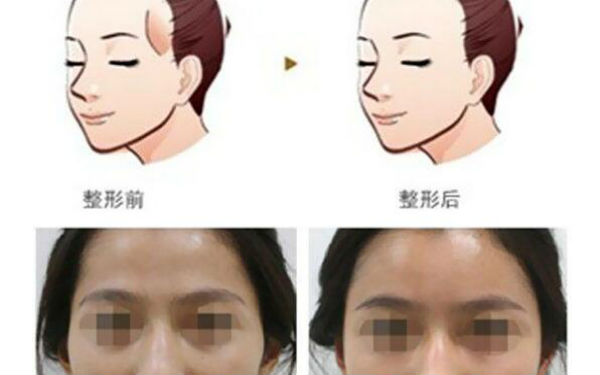 洛陽哪家醫(yī)院做木偶紋效果好？2023榜單出爐，洛陽物理去木偶紋top10佳選露面！