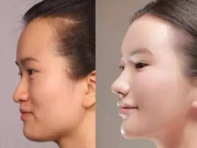 2023年，哪些上海自體脂肪面部精雕整形醫(yī)院的口碑特別好？排名榜前十值得信賴的美容整形醫(yī)院！