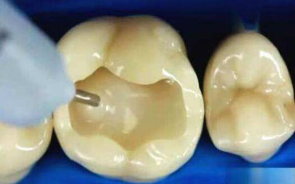 廣州哪家醫(yī)院針雕祛除眉間紋效果比較好？2023年排名前十名單揭曉！