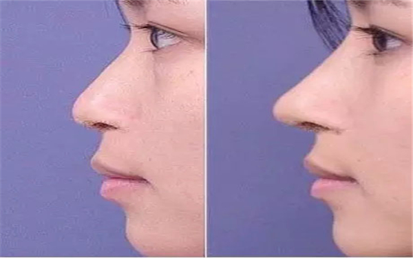 2023年貴州去除魚尾紋整形醫(yī)院排名解析