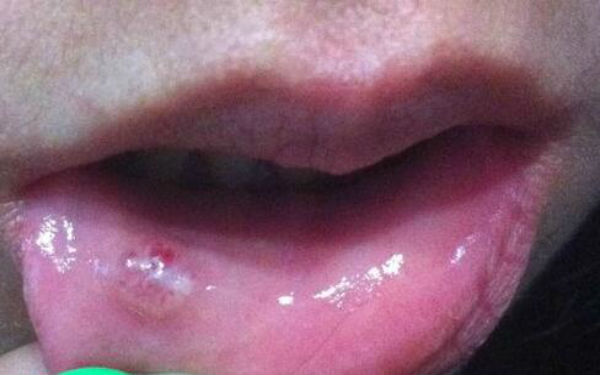 南寧細(xì)胞激光去額頭紋醫(yī)生