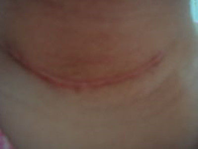 徐州玻尿酸注射法令紋醫(yī)生