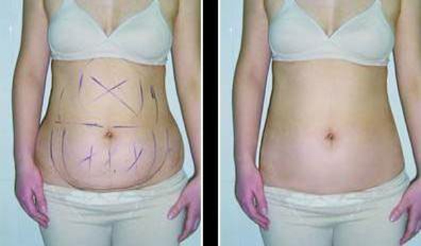 佛山非常受歡迎的雙眼皮納米手術(shù)醫(yī)院排行榜，詳細(xì)揭秘2023年前10名醫(yī)療整形機(jī)構(gòu)！