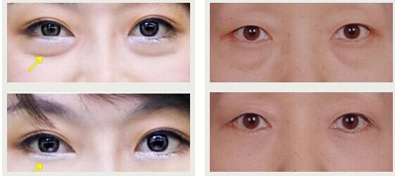 東莞有哪些效果好的川字紋除皺醫(yī)院？2023年?yáng)|莞十大正規(guī)醫(yī)院排行榜出爐！