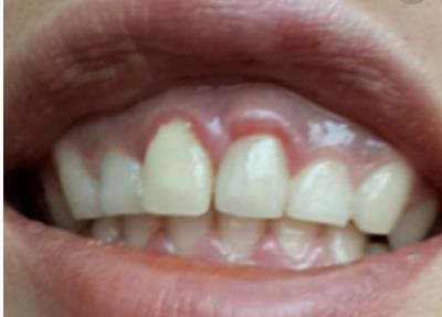 黃石哪家醫(yī)院能填充太陽穴假體？2023黃石太陽穴美容前十有哪些好選擇！