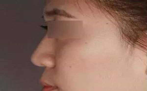 2023年?？谏漕l微針去眼角細紋哪個醫(yī)院比較好？?？谘劢羌毤y整形美容醫(yī)院排行榜綜合報道！