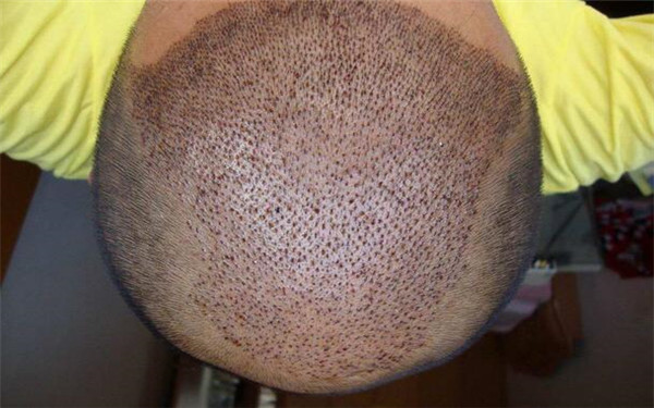 2023年比較好的中國光纖祛眼袋醫(yī)療整形醫(yī)院排名TOP10發(fā)布！哪家醫(yī)院做得比較好？