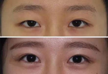 杭州駝峰鼻矯正哪家整形醫(yī)院技術(shù)獨(dú)特？2023杭州駝峰鼻矯正排名前10的醫(yī)院評(píng)測(cè)揭曉！