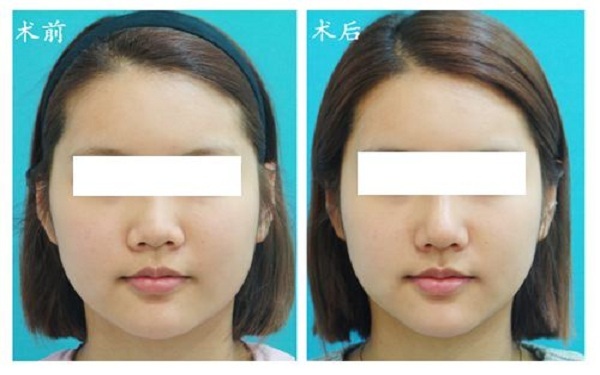 南陽哪家醫(yī)院注射鼻基底效果好？2023南陽玻尿酸注射鼻基底排行榜出爐！全城皆贊的十大醫(yī)院盤點！