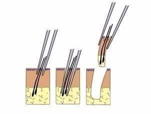 2023鄭州哪家整形醫(yī)院口碑好？眼角紋去除效果！