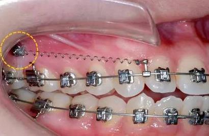 杭州哪家醫(yī)院做玻尿酸填充淚溝好？2023年排行榜公布！