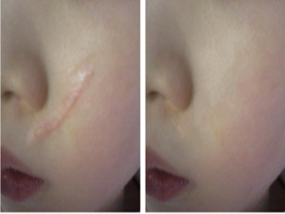 綿陽雙眼皮整形及修復醫(yī)生